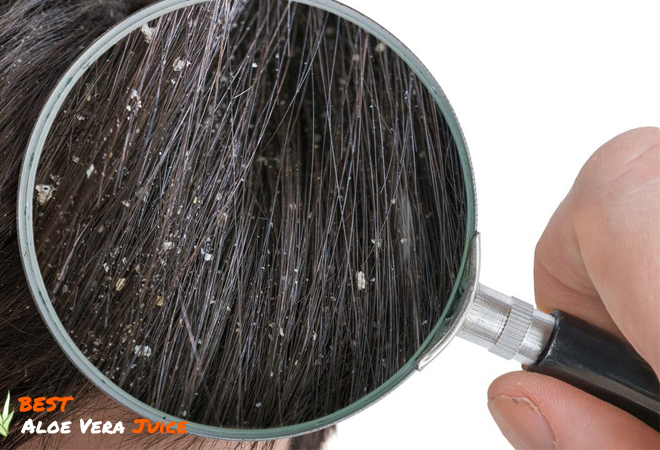ALOE VERA GEL FOR DANDRUFF 