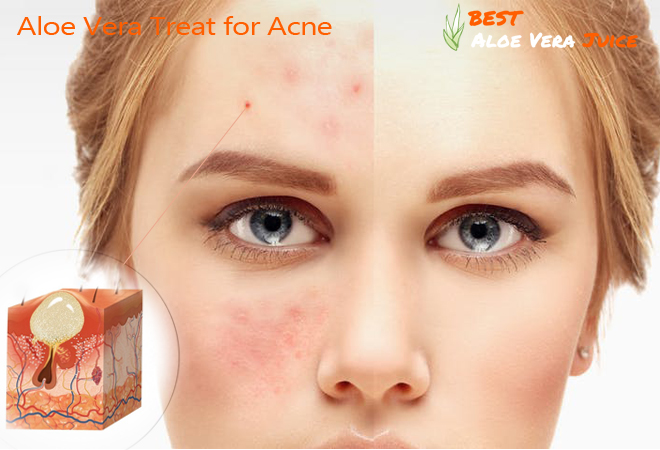 Aloe Vera Treat for Acne