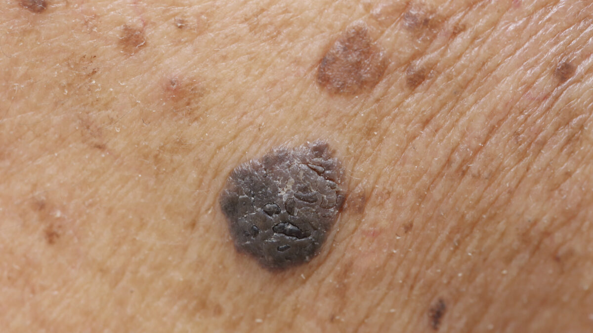 Black Salve Is a Dangerous Scam