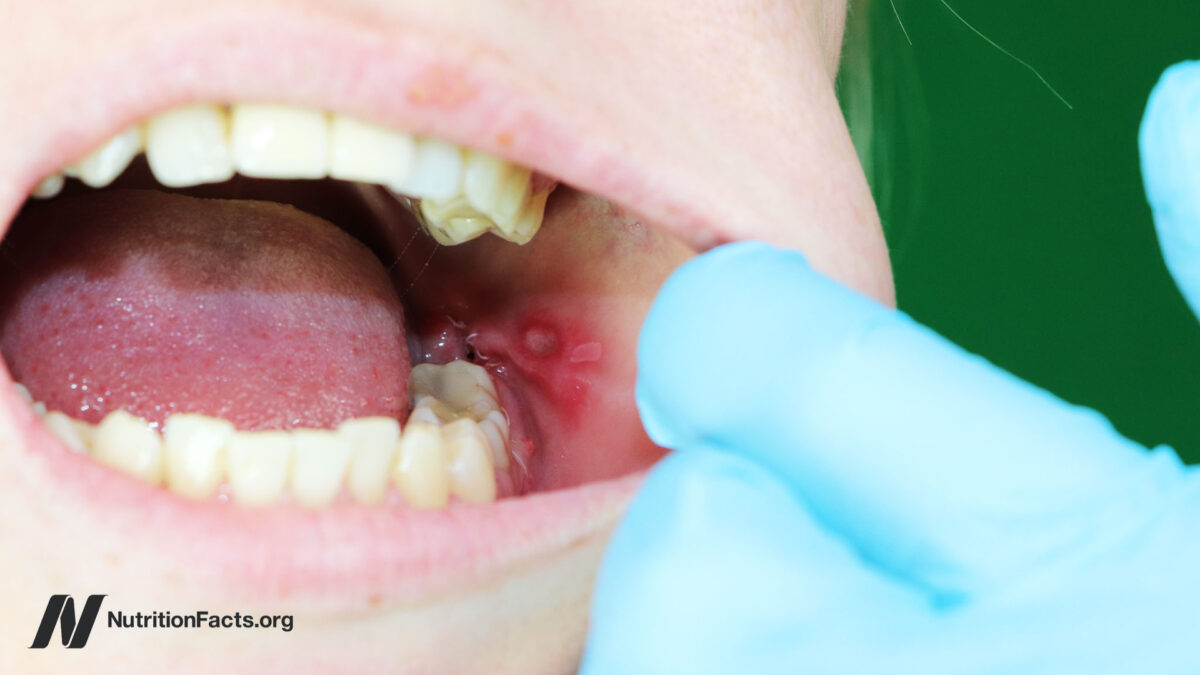 How to Treat Canker Sores