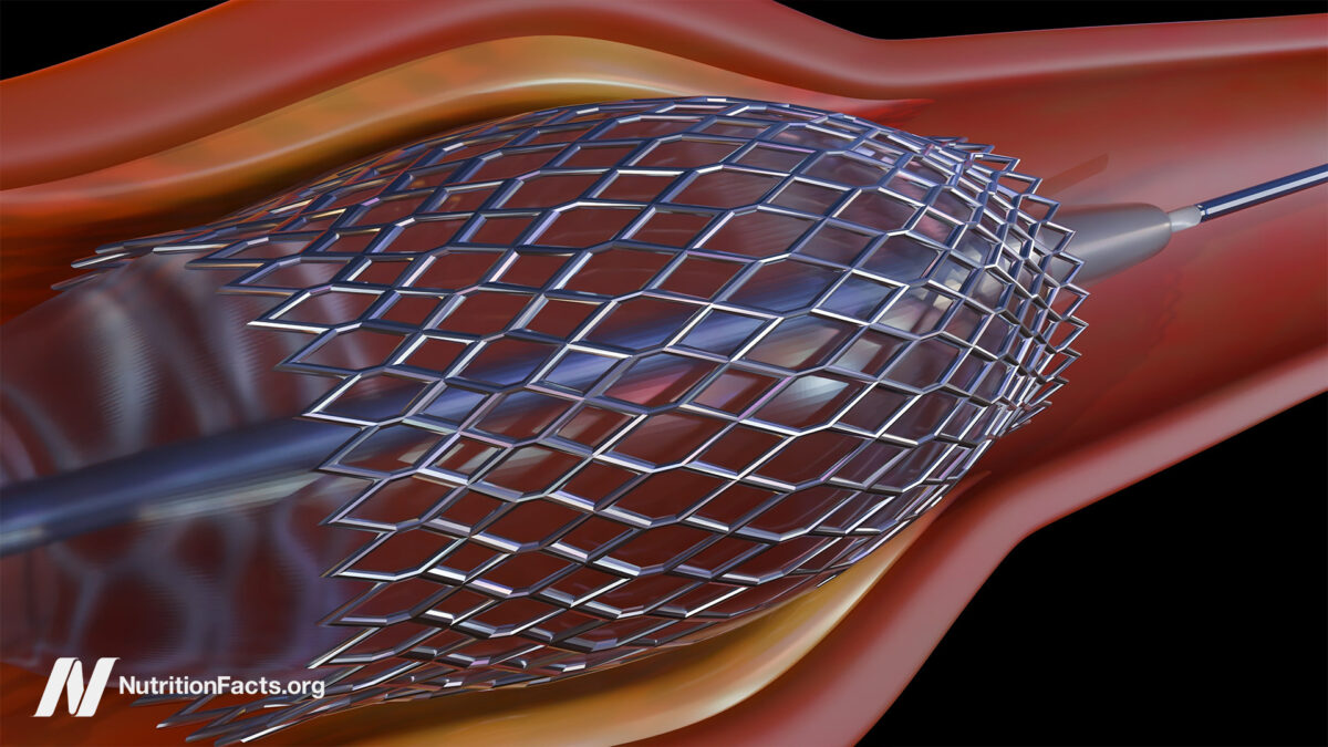 Heart Stents and Their Risks 