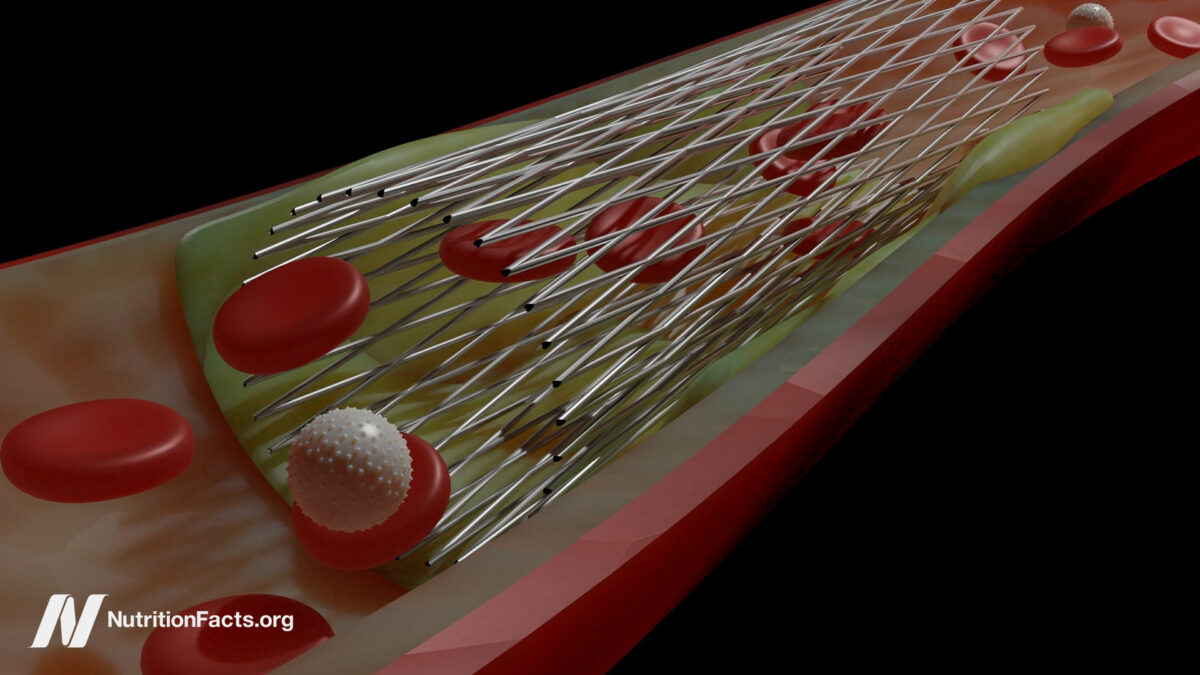 Do Heart Stents Benefit Angina Chest Pain? 